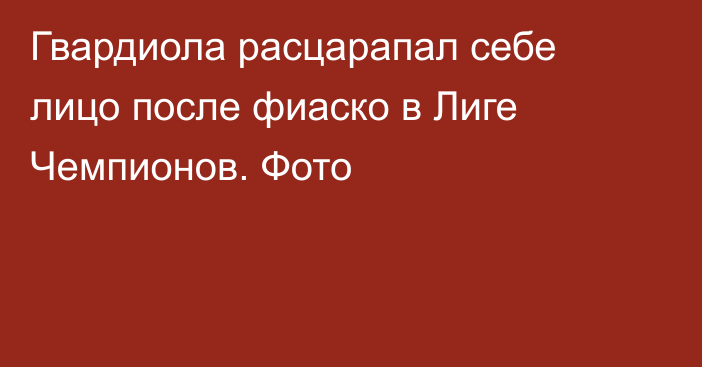 Гвардиола расцарапал себе лицо после фиаско в Лиге Чемпионов. Фото